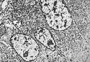M, 49y. | pancreatic tumor (insulinoma v.s.) M, 49y. | pancreatic tumor (insulinoma v.s.)
